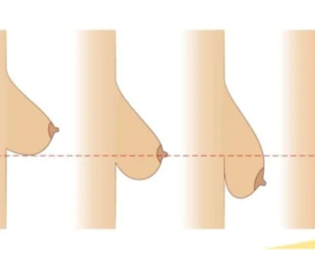 Best Bras for Sagging Breasts